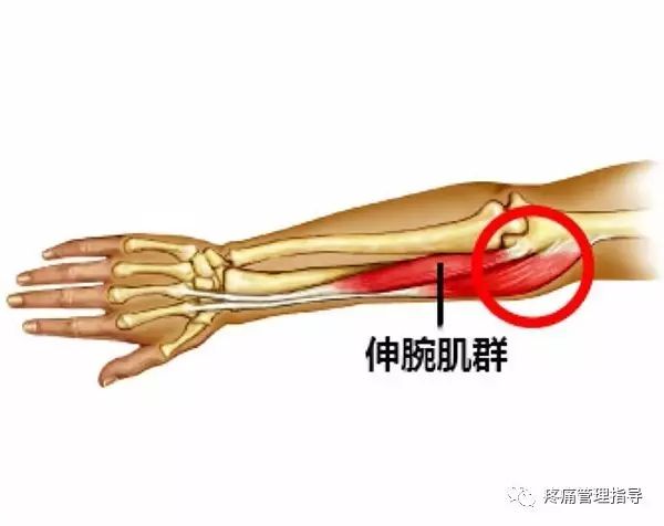 网球肘能自我恢复吗,网球肘病因的解剖学研究