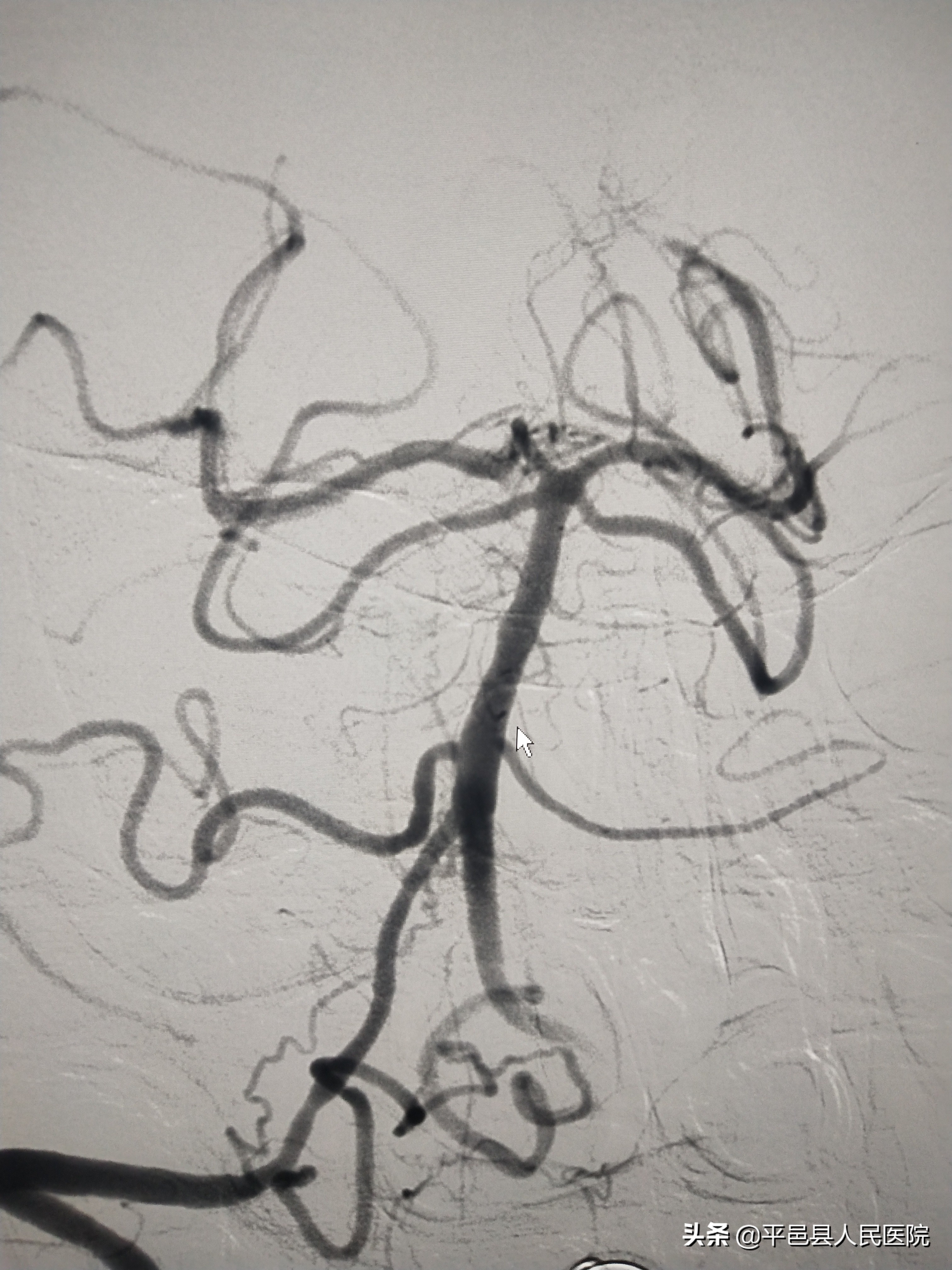 【特色诊疗】平邑人身边放心的“国家级示范防治卒中中心”不负百姓健康重托