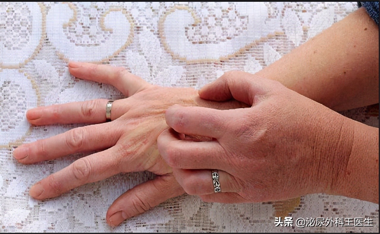 小腿瘙痒是不是糖尿病的并发症,糖尿病胳膊腿瘙痒是并发症严重了