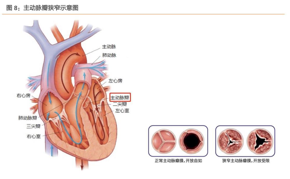 启明医疗人工心脏瓣膜的优势,启明医疗心脏瓣膜研发