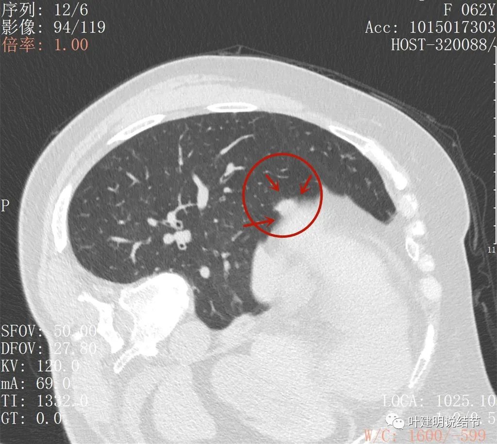 左肺癌手术半年右肺下角还有炎症,左下肺癌晚期