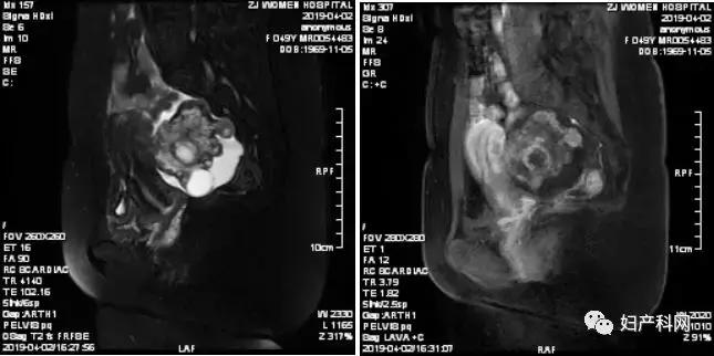 乳腺癌卵巢转移病例,乳腺癌病例分析ta2