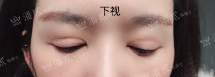 10个工作室做，9个毁，祛眼袋连卧蚕也没了，直接送我到10年后