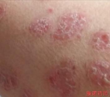 生物制剂治疗银屑病机制,银屑病注射生物制剂的危害