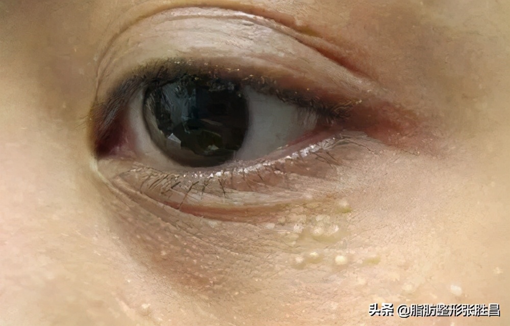 眼部长脂肪粒怎么清除,眼部长了脂肪粒怎么去除
