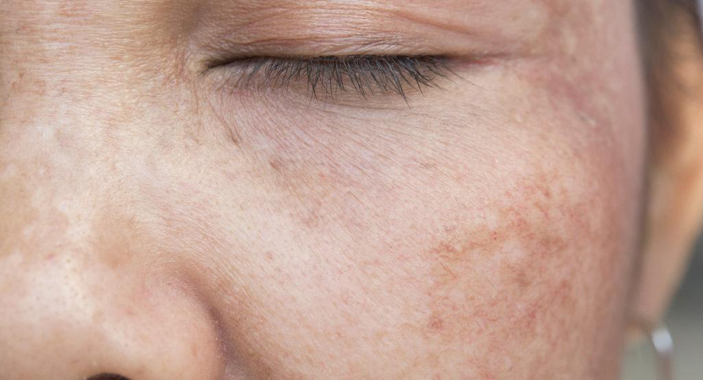 脸上的色斑是怎么来的,脸上色斑是怎么来的