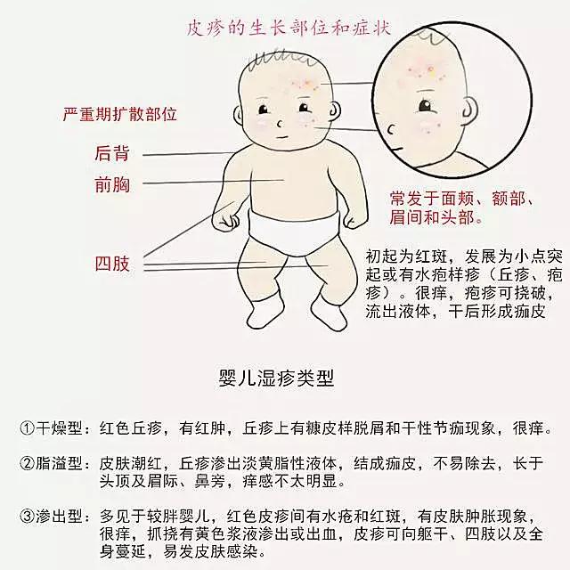 婴幼儿湿疹如何护理崔玉涛,简述婴幼儿湿疹的护理措施