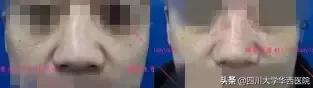 鼻子太翘怎么整形,鼻子太尖整形修复最佳方法