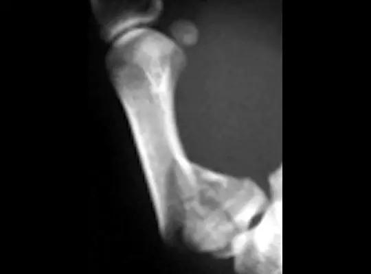 所有骨折都叫什么名字,骨折的名称有哪些