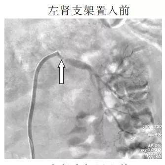 血肌酐118可以降到正常吗,肌酐136肾功能损伤严重吗