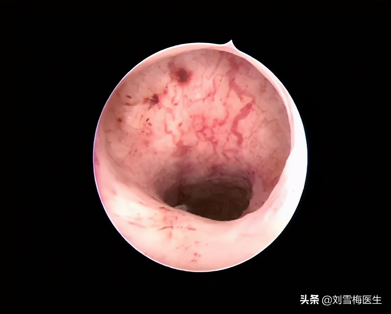 刘雪梅医生视频,刘雪梅大夫