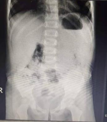 1例肠套叠患儿治疗后出现感冒，经治疗后好转