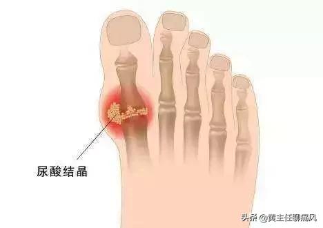 碳酸氢钠片辅助降尿酸如何吃,碳酸氢钠一片要兑多少水服用