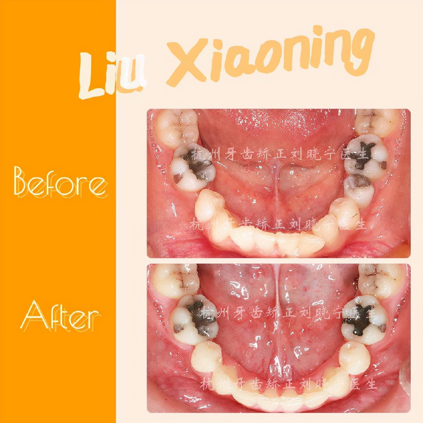 杭州舌侧牙齿矫正,舌侧矫正杭州价格