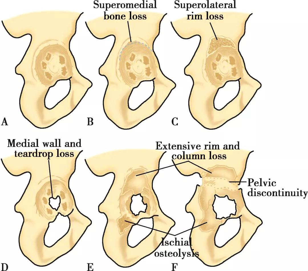 髋关节翻修术手术流程,人工髋关节翻修材料的选择