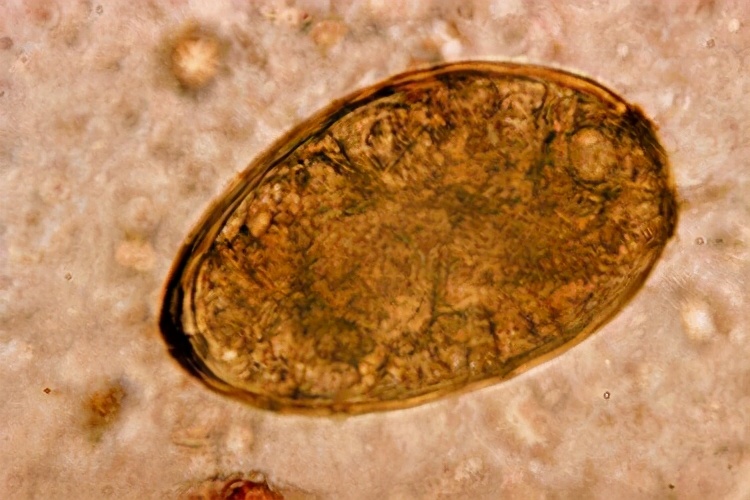 小孩喝了溪水的脏水发烧,头痛欲裂有可能是寄生虫吗