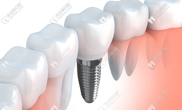 苏州最便宜的种植牙多少钱,苏州口腔种植牙价目表最新