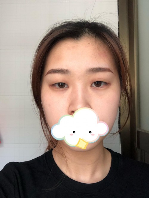 修志夫做双眼皮效果怎么样,修志夫双眼皮修复