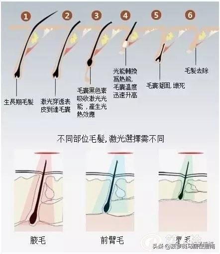最简单的脱毛大法,推荐5个脱毛方法