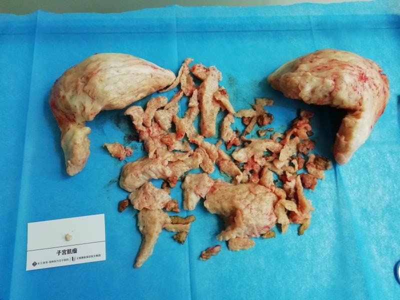 原发性痛经非常剧烈,痛经12级怎么办