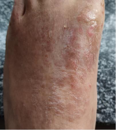 双脚心对称性皮炎是何病,双小腿对称性神经性皮炎怎么治疗