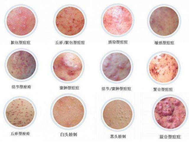 毛孔粗大痘印痘坑修复的护肤方法,有痘印痘坑怎么用护肤品消除