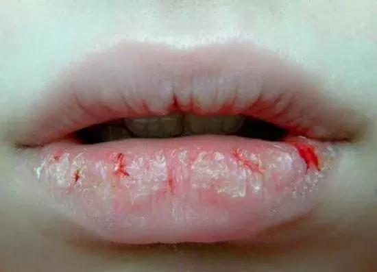 冬季烂嘴角是怎么回事,烂嘴角是因为上火吗