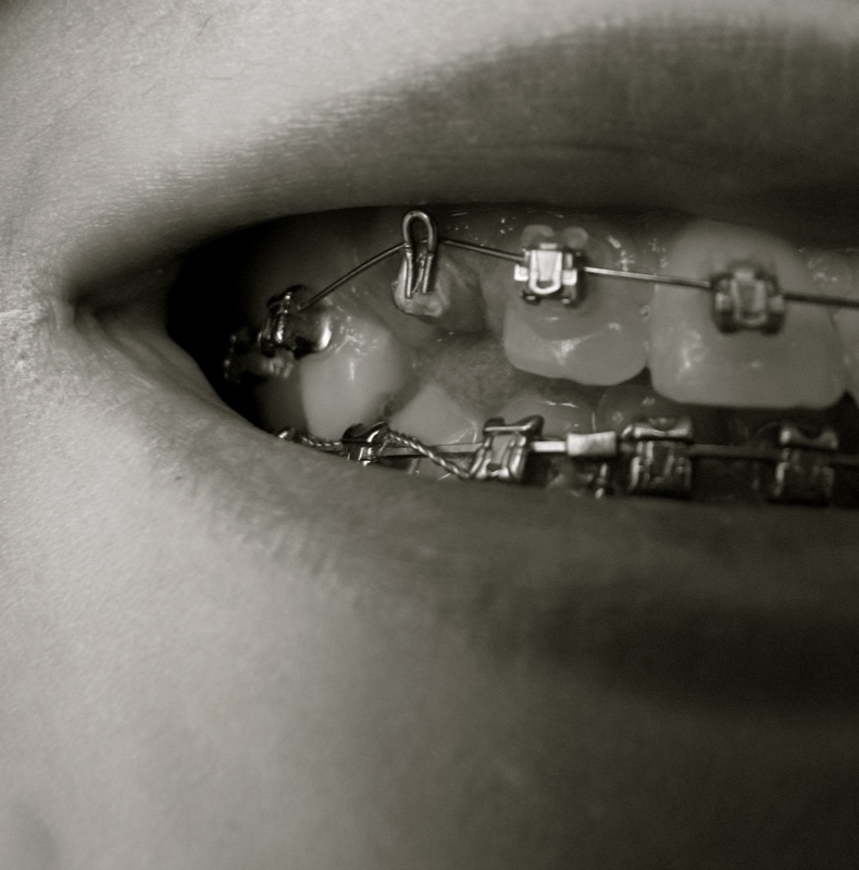 正畸后有反弹迹象怎么办,正畸矫正后反弹怎么办