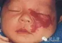 宝宝身上有点小红点,宝宝身上红色胎记但是不凸起