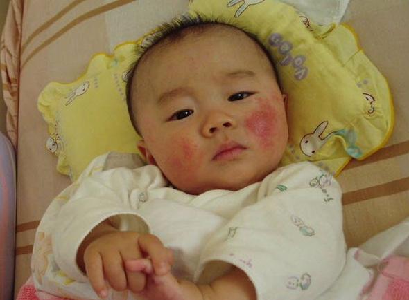 新生儿身上有疹子涂抹什么管用呢,新生儿身上出现小红疹怎么办