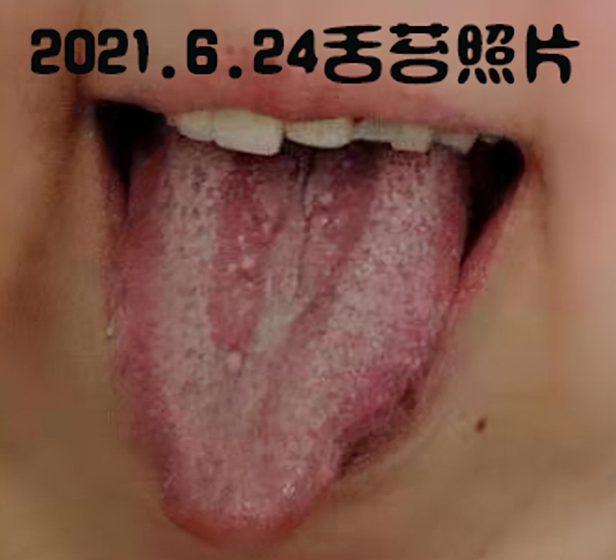 高热不退特效药中药方,持续高烧不退中药经方治疗