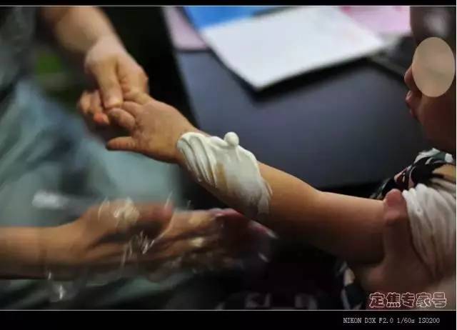 湿疹治不好会是心理原因吗,湿疹是湿还是干引起的