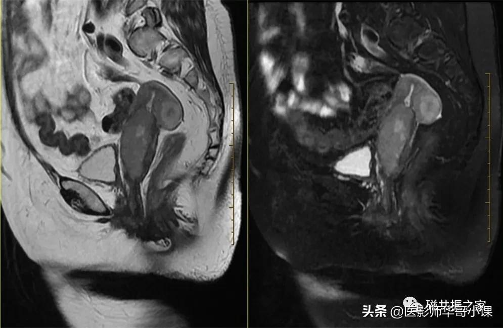 「精品课件」带大家看看,磁共振子宫MRI要如何扫描?