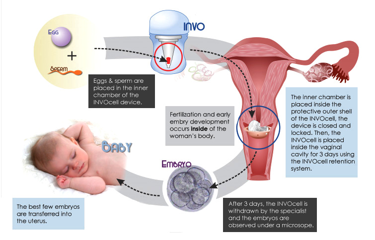 世界首创！美国两位同*伴侣性**的身体孕育同一个婴儿