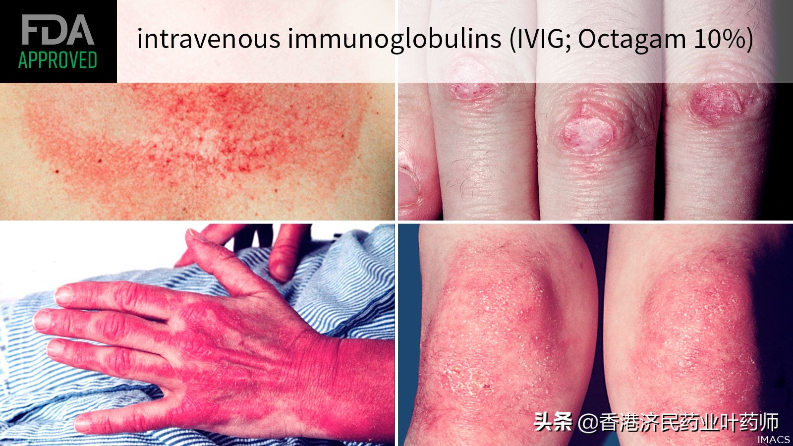 皮肌炎10%免疫球蛋白,皮肌炎新药有望治愈