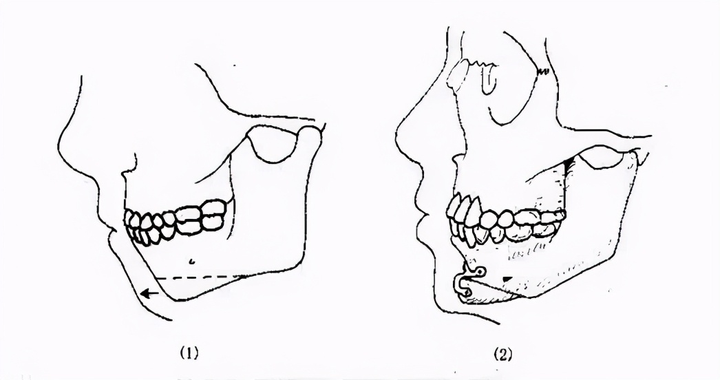 韦敏削骨怎么样,韦敏做peek下巴多少钱