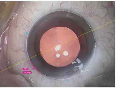 临沂市人民医院白内障手术,临沂罗庄免费白内障手术