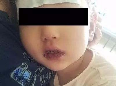 孩子反复高烧是吓到了吗,儿童高烧反复要警惕什么病