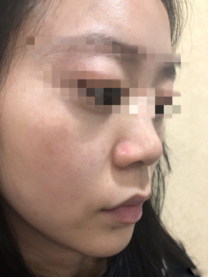 点阵激光能修复到什么程度,点阵激光凹陷疤痕能修复多少