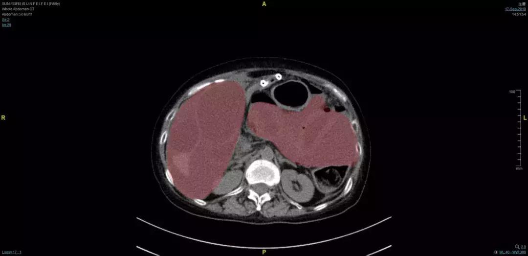 脂肪肉瘤侵犯小肠,肉瘤侵犯胸肋骨
