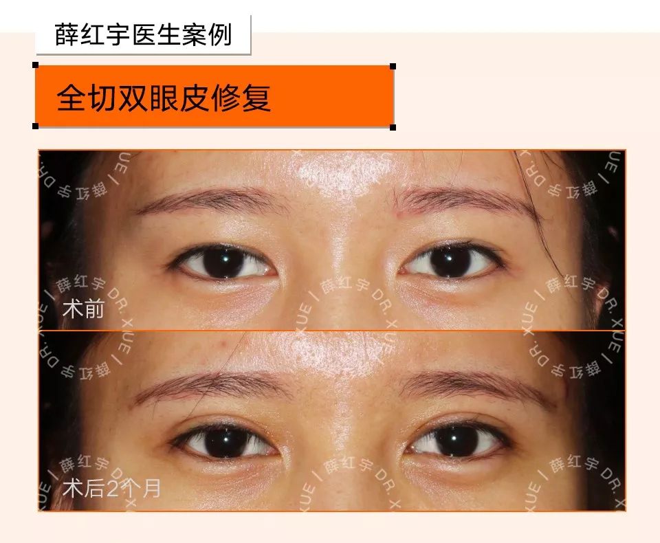 双眼皮整形修复,潘贰双眼皮修复