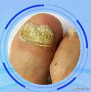 灰指甲足癣有什么偏方,灰指甲脚气湿疹