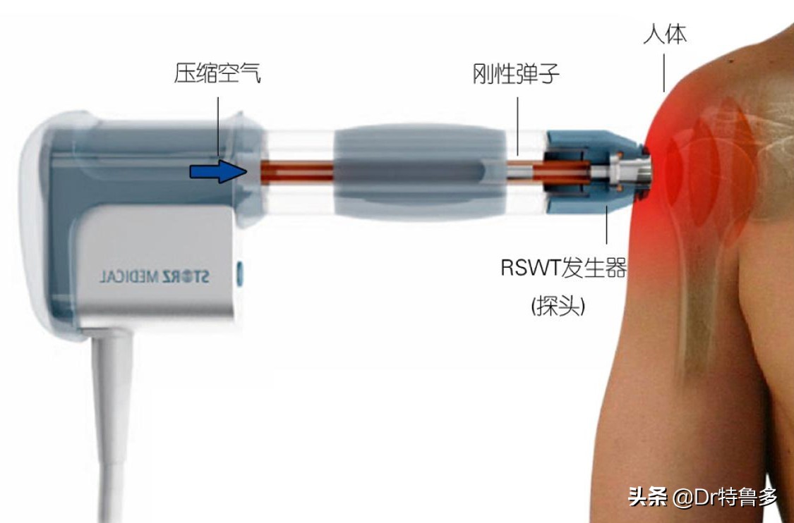 骨折了不长、长得慢怎么办？试试冲击波治疗吧