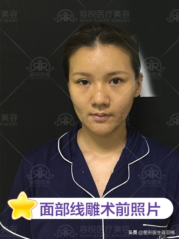 线雕完觉得自己像阿凡达,线雕的真实感受图片