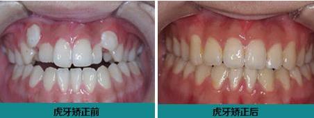 为什么人会长牙,为什么会有人长兔牙