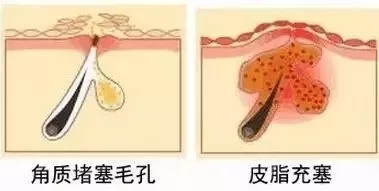闭口性粉刺怎么去除,闭口性粉刺怎么去除最快