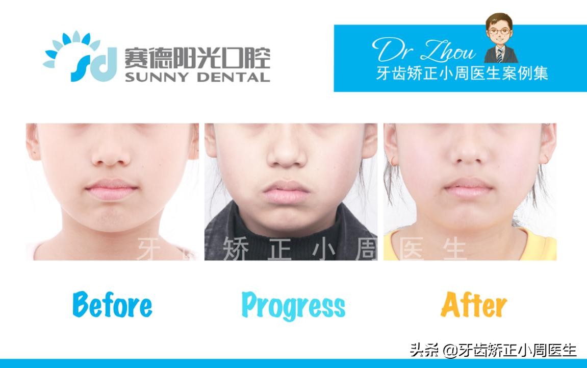 下巴后缩整容玻尿酸还是假体,如何不靠整容改变下巴