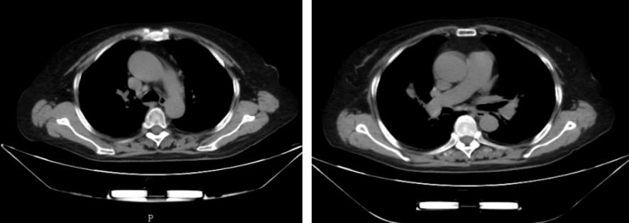 鍖荤敓鏃犳硶鍒ゆ柇缁撹妭鐥呰繕鏄粨鏍哥梾,鏈夎偤缁撴牳鐥呭彶鍗佸嚑骞存煡鍑鸿偤缁撹妭