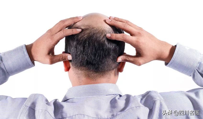 冉玉平医生治脱发怎么样,四川大学华西医院斑秃专家冉玉平