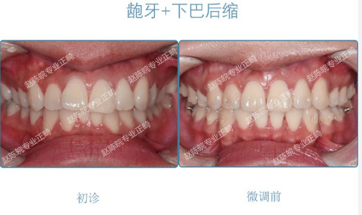 杭州成人隐形矫正牙齿优惠,矫正牙齿杭州无创伤